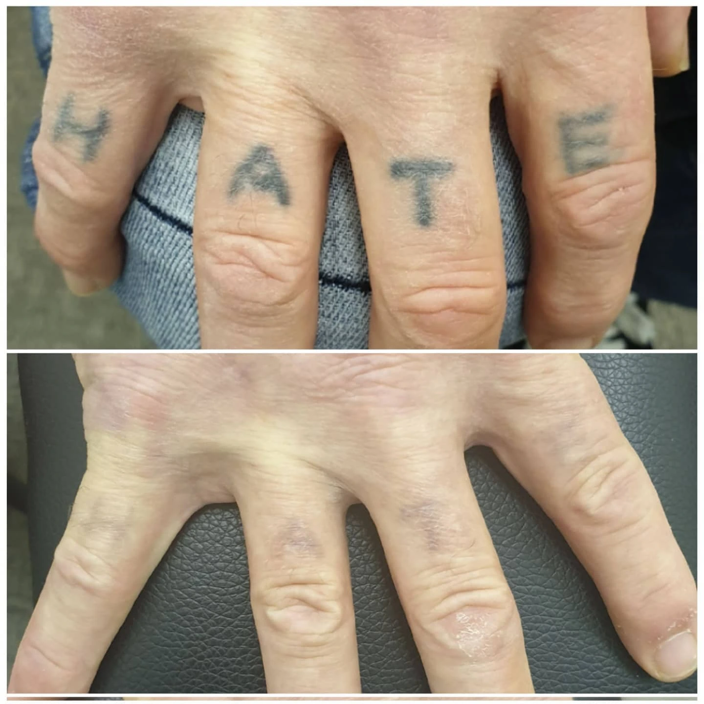 Andre før og etter-resultat av laserfjerning av tatovering hos Eternal Sign i Fredrikstad