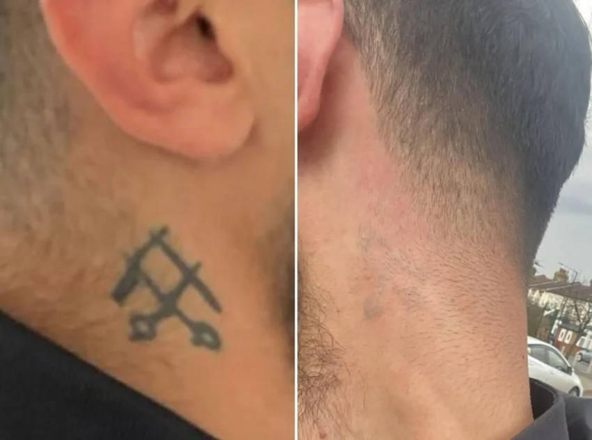 Før og etter laserfjerning av tatovering hos Eternal Sign i Fredrikstad