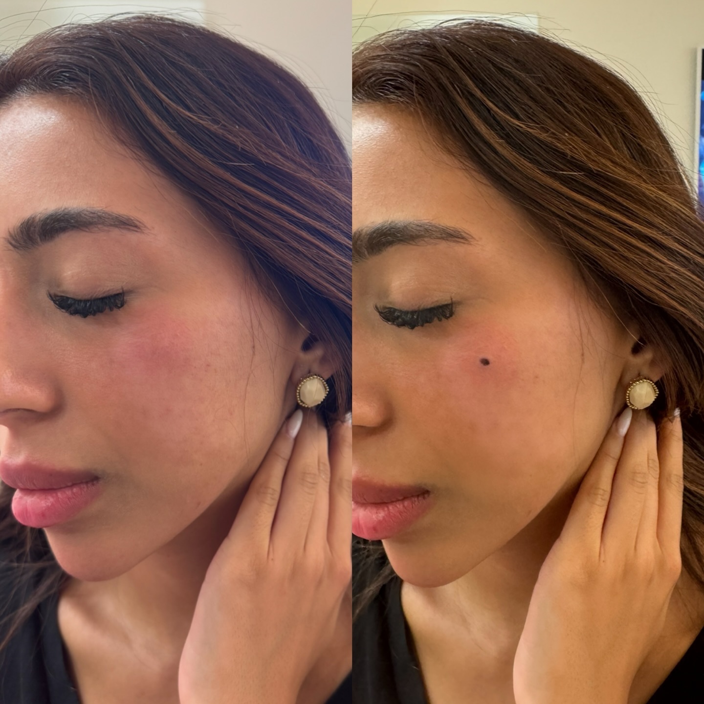 Skjønnhetsflekk (beauty spot) pigmentert i ansiktet, Eternal Sign Fredrikstad